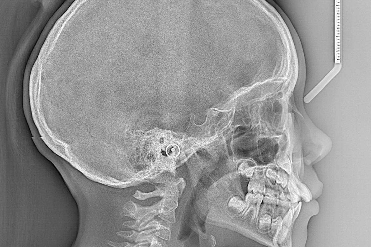 Radiografía panorámica (referencial)