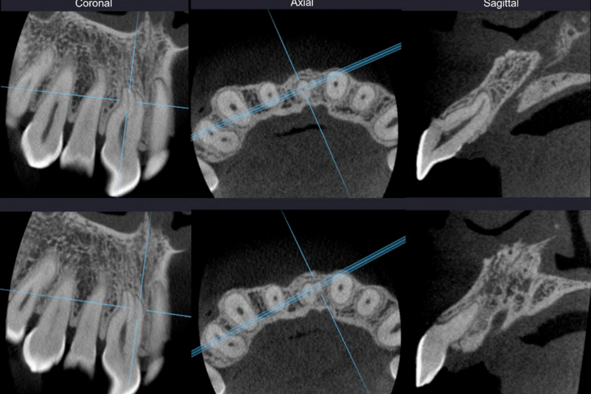 Cortes CBCT (referencial)